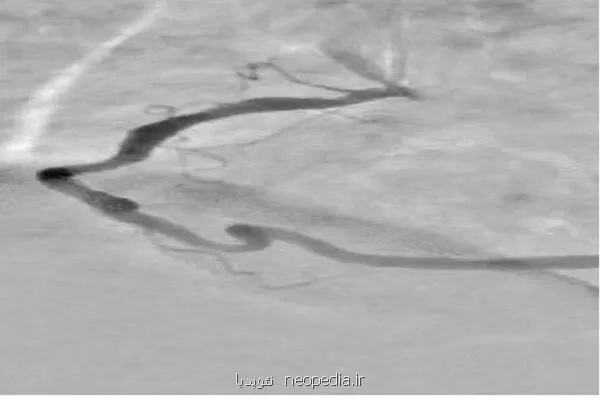 امکان افزایش دقت نمایش عروق کرونری قلب با شیوه های مبتنی بر هوش مصنوعی